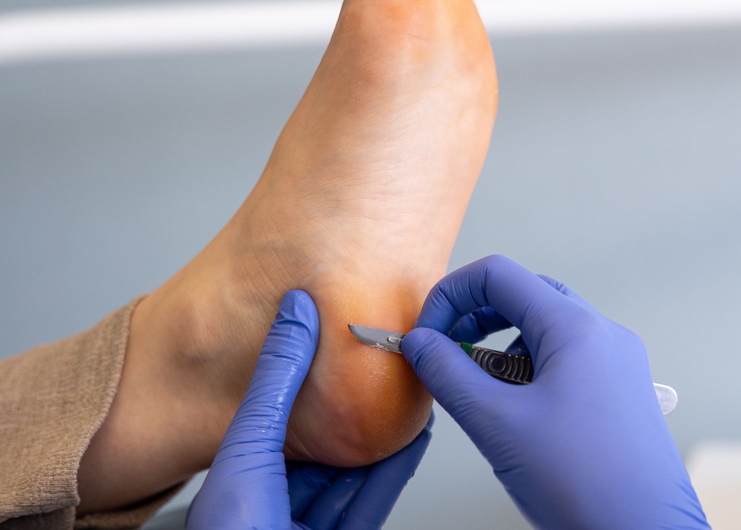 Callosités : comment enlever la corne des pieds ?