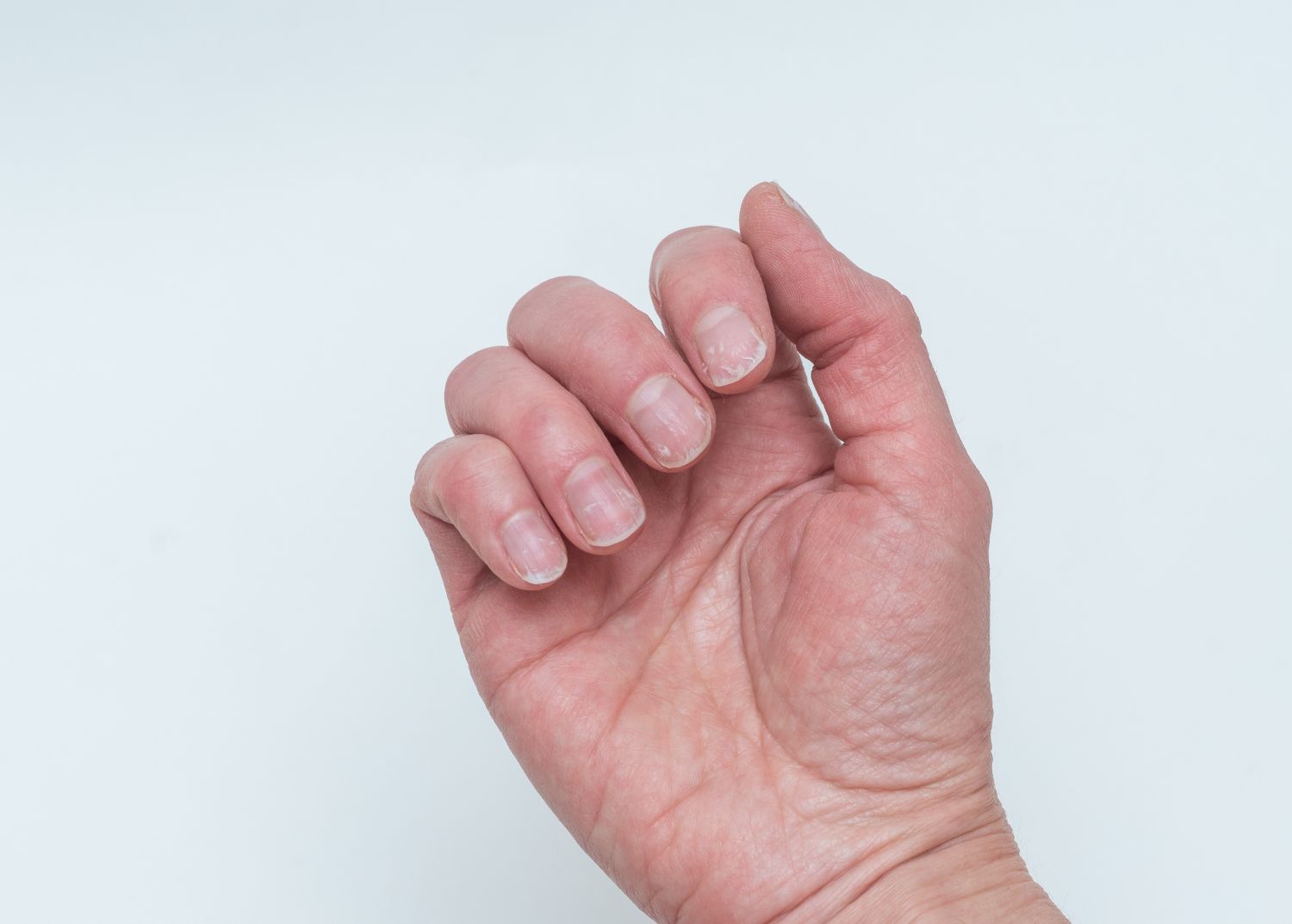 Ongles striés : causes et solutions