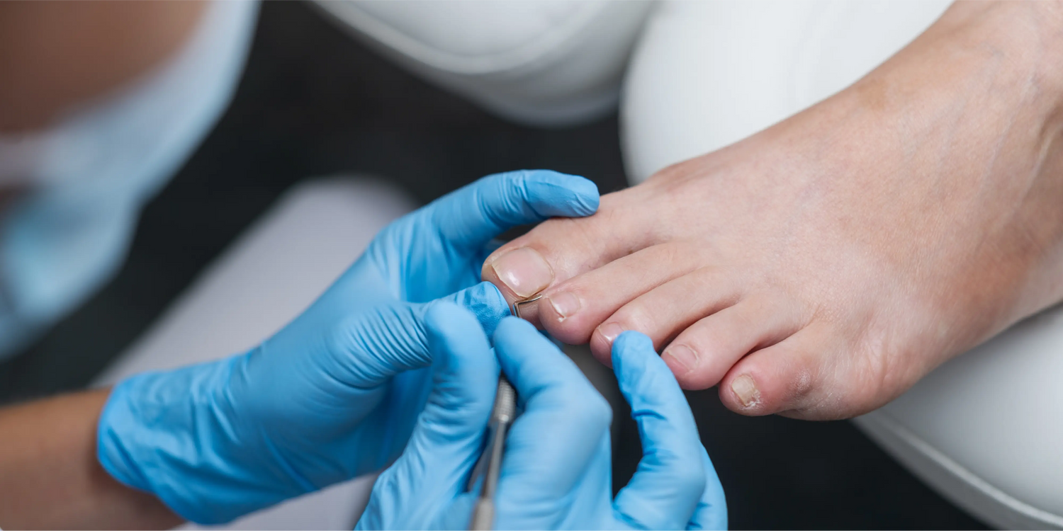 Le crayon au nitrate d’argent pour mon ongle incarné