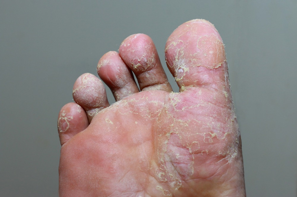 Mycose du pied : symptômes et traitements