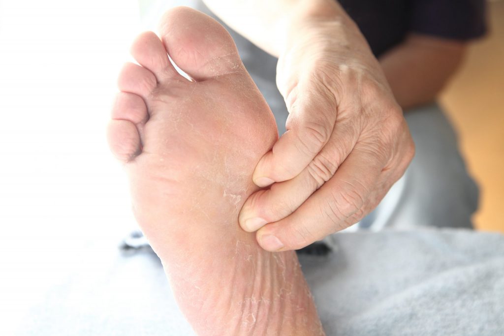 Mycose de pied : traitement au bicarbonate de soude