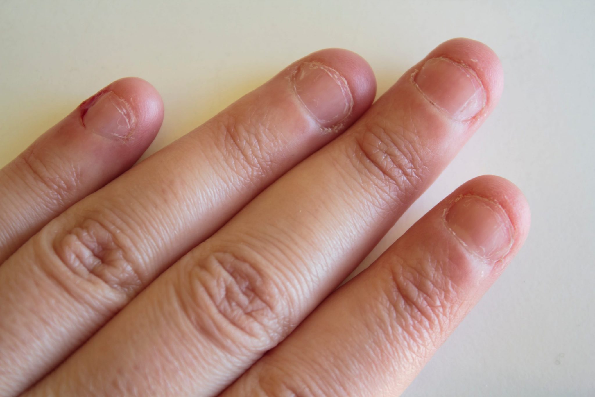 Некрасивые обгрызанные ногти