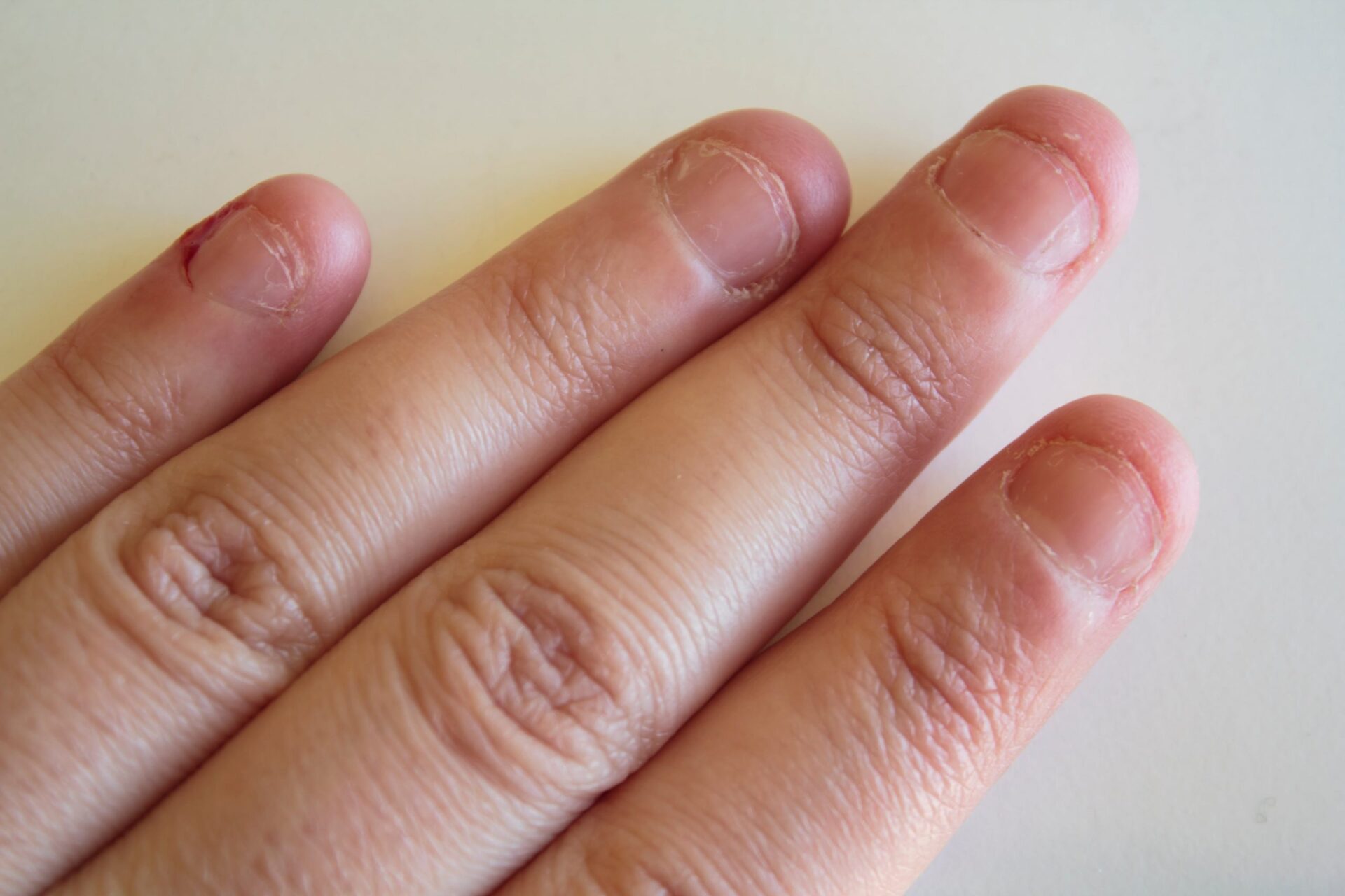 Traitement de rongement des ongles pour les enfants, vernis à