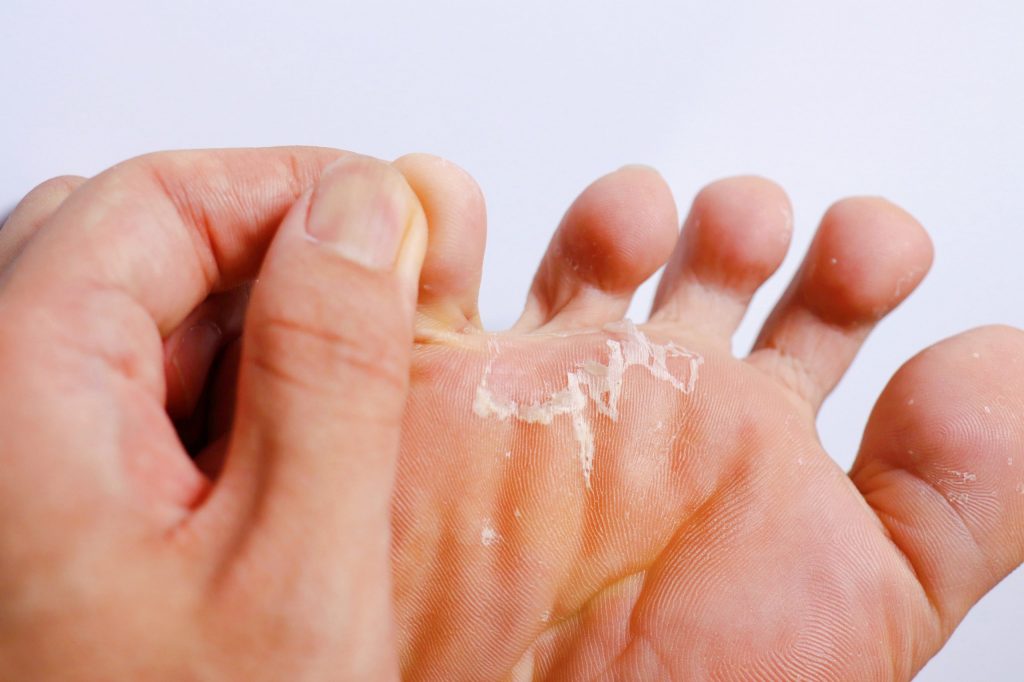 Mycose du pied : symptômes et traitements